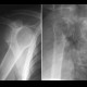 Anterior dislocation of shoulder: X-ray - Plain radiograph
